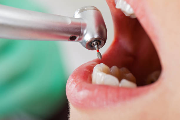 Best Chipped Tooth Repair Near Me  in Shenandoah, LA